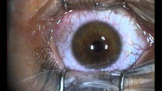 cirugia laser prk