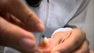tratamiento de conducto, endodoncia convencional.