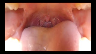 GoPro inside my mouth!