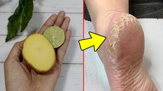 TUMIT KASAR DAN KERING ATAU KAKI PECAH-PECAH PARAH, KEMBALI MULUS DENGAN RESEP INI 