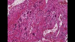 Histopathology Uterus--Syncytial endometritis