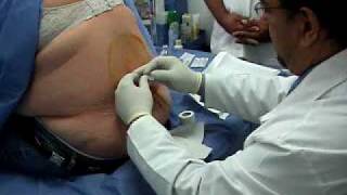 ozono epidural