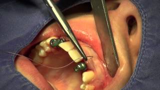 Zahn-OP Dr. Blum - Keystone Implantat,