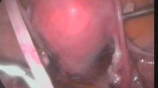 Vahab`s method of Laparoscopic uterine sling,Cervicopexy,Uteropexy.