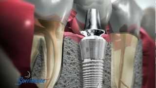 Manutenção de Implantes com Dr. Bianchini - Sorridente SPA Odontológico
