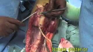 Below Knee Amputation 2