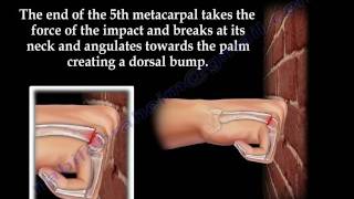 Boxer's Fracture - Everything You Need To Know - Dr. Nabil Ebraheim