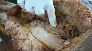 MBBS 1st year anatomy: BACK OF THIGH(GLUTEAL REGION) DISSECTON