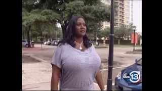 Biggest Natural Breasts in Texas – 36NNN Breast Reduction by Dr. Franklin Rose