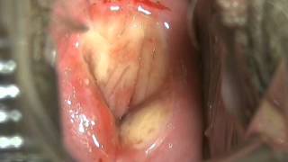 Cervix freezing2