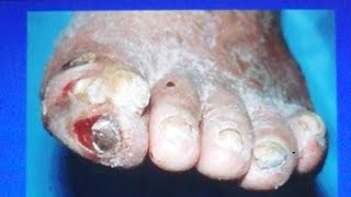 Vascular Disease, Varicose Veins