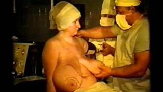 Лечение макромастии - treatment makromastya