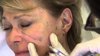 Dr Laurent Dumas - Injection ovale du visage, Radiesse et acide hyaluronique