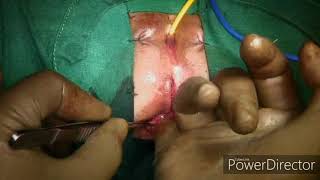 Anteposed anus in children Anterior sagital anorectoplasty surgery