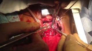 MICS CABG-3