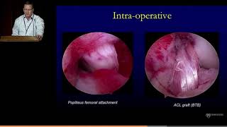 Anatomic Posterolateral Corner Reconstruction