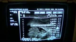 FETAL ANOMALY GU system