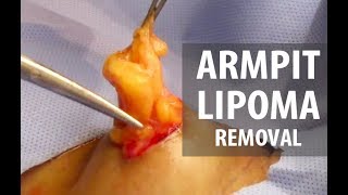 Armpit Lipoma Removal | Dr. Derm