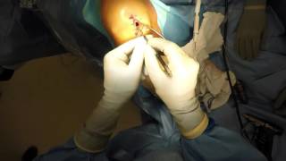 Fresh osteochondral allograft plug technique