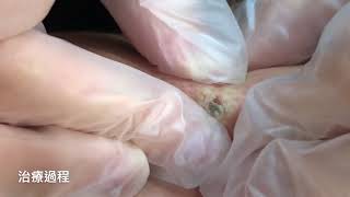 背部小顆粉瘤取出 美麗新城診所莊禮謙醫師 Extraction of Baby Epidermoid Cyst on Back, Dr George, 桃園中壢
