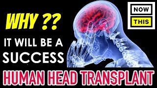 LATEST UPDATE ☆☆ Human Head Transplant  to happen in 2018