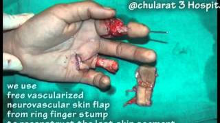 mutilated hand case 17