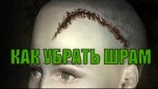 Как убрать шрам на голове? ОТВЕТ!