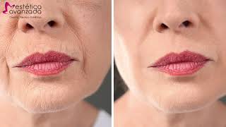 Hyaluronic Pen