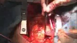 Koroner Arter Ameliyatı - Coronary Artery Surgery