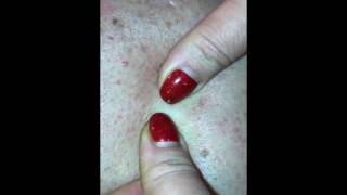 Выдавливание черных угрей/Squeezing blackheads
