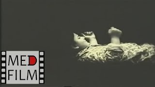 Припадки. Фокальные (парциальные) эпиприпадки © EPILEPSY, Focal (partial) epimetriosis