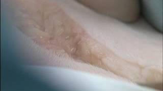 Scalpel incision of sub q