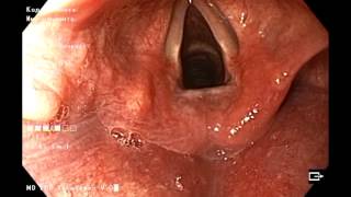 Orophatyngeal manifestations of gastroesophageal reflux disease. Внепищеводные признаки рефлюкса.