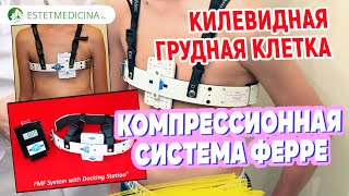Килевидная грудная клетка: лечение динамической системой | Pectus Carinatum
