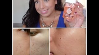 Bio Oil : Mon bilan ! (Avant/Après)
