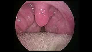 巨大扁桃腺合併打呼-睡眠呼吸中止症(huge tonsils with snoring and OSAS)