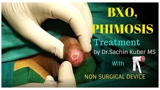 BXO,Phimosis Treatment with Non Surgical Circumcision by Dr.Kuber Call +919370275336/+919370240098