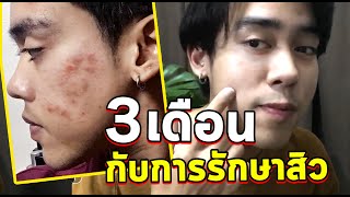[Men Beauty]  ความในใจของคนเป็นสิวที่อยากระบาย | Boy From Mars