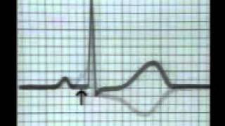 Learning ECG - WPW Syndrome