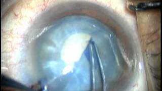 Azul de Tripano como Corante Vital para Superfície Ocular_Renato Ambrósio.VOB