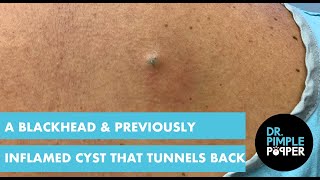 A Blackhead & A Previously Inflamed Cyst that Tunnels Back