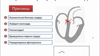 АВ блокады и ее степени на ЭКГ (атривентрикулярные блокады) - meduniver.com