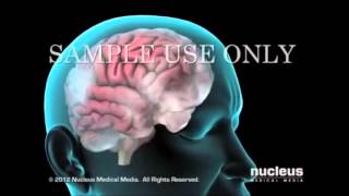FIBROMIALGIA ANIMACION EN ESPAñOL.  NUCLEUS.