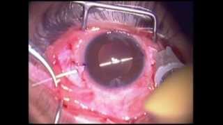 Scleral Fixated IOL