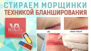 #Бланширование (лечение морщин)