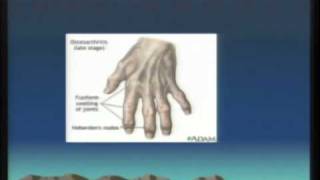 Let's Talk About: Osteoarthritis (1/2)