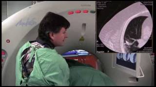 Radiofrequency ablation of colorectal metastasis to lung
