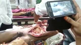 Medical Students Attend Autopsy of Young Male  #8211; Miscopy