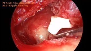Phẫu thuật Nội soi Tai thay thế xương con - Bệnh viêm tai giữa xơ nhĩ