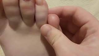 Toe Nub 1 Month Post Amputation